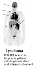 An FDG PET scan in a lymphoma patient, including brain, chest and spleen involvement.